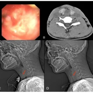 Interventional Radiology Techniques for Treating Gastroesophageal Reflux